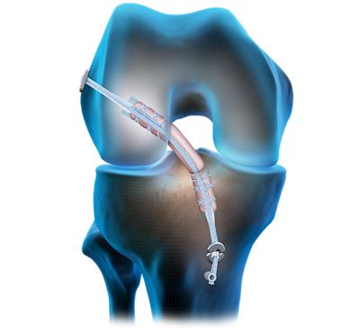 Arthrex Acl Reconstruction